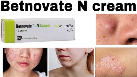 what is betnovate used for.